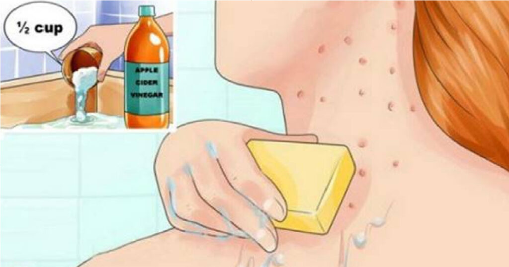 Oto jak wykorzystać ocet jabłkowy na problemy skórne!  Absolutnie fantastyczne rezultaty Náhledový obrázek